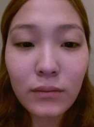 【点击哦页面上咨询窗口与觅美网*在线交流】 双眼皮修复手术案例图