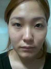 【点击哦页面上咨询窗口与觅美网*在线交流】 双眼皮修复手术案例图