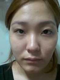 【点击哦页面上咨询窗口与觅美网*在线交流】 双眼皮修复手术案例图