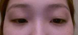 【点击哦页面上咨询窗口与觅美网*在线交流】 双眼皮修复手术案例图