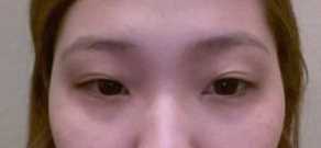 【点击哦页面上咨询窗口与觅美网*在线交流】 双眼皮修复手术案例图
