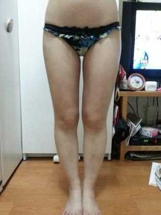 大腿吸脂术后3个月