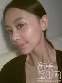 截骨+鼻中隔+硅胶隆鼻手术5个月后