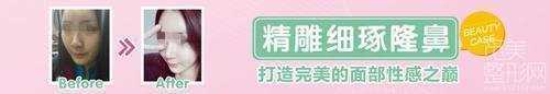 深圳市人民医院整形科打玻尿酸怎么样？价格表