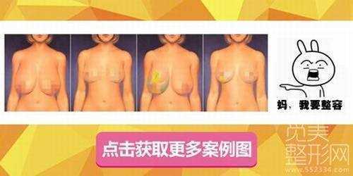 上海九院整形科巨乳缩小怎么样