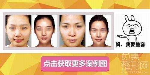 北京王军隆鼻修复怎么样？多少钱？
