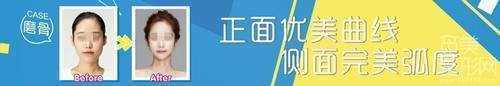 济南省立医院整形科磨腮削骨多少钱？案例图