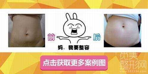 沈阳杏林整形外科医院去妊娠纹*果好吗？