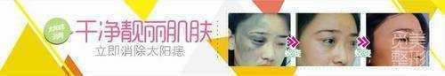 西京医院去太田痣价格表