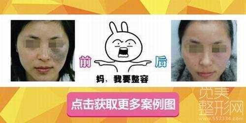 西京医院去太田痣价格表