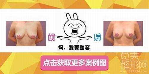 西京医院乳房下垂矫正价格表