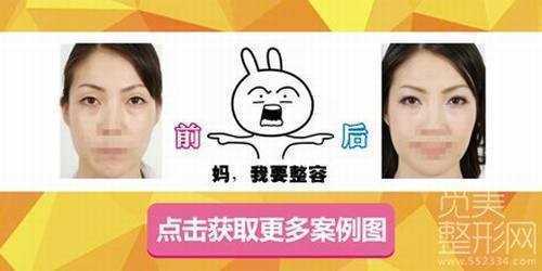 济南省立医院整形科双眼皮修复多少钱？案例图