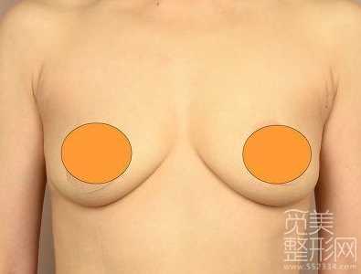 上周做了水滴形隆胸手术~