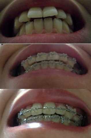 牙齿矫正手术