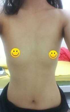 假体隆胸术后3个月后