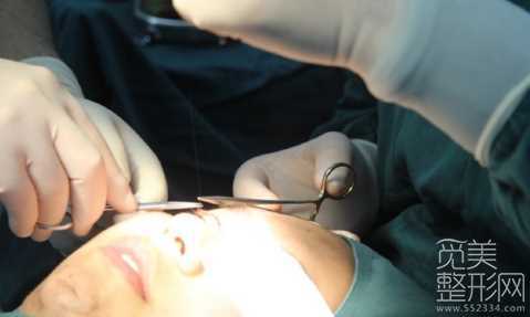 双眼皮手术细节 韩式三点双眼皮