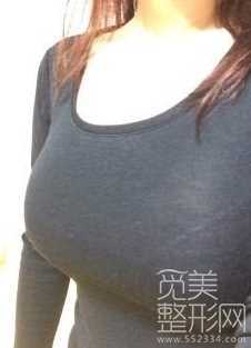 假体隆胸手术 能保持多久 *的