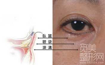 【解答】我这个适合玻尿酸丰泪沟的吗？