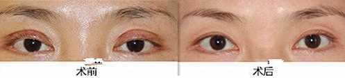 双眼皮介绍 割双眼皮有什么坏处吗？