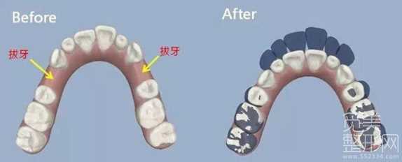 牙齿矫正为什么要拔牙?解答