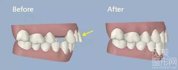牙齿矫正为什么要拔牙?解答
