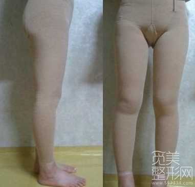 大腿吸脂手术4个周后
