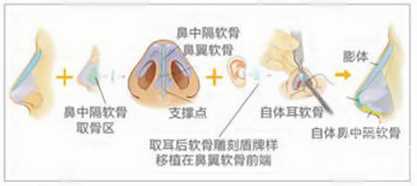 硅胶隆鼻可以终身*吗？