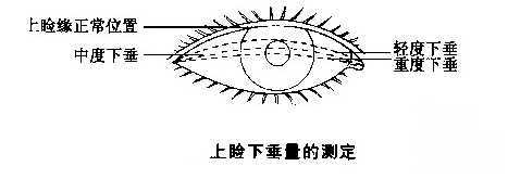 上眼睑下垂的矫正方法有哪些？