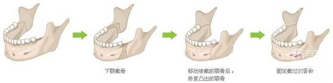 削骨手术如何避免后遗症 削骨手术介绍