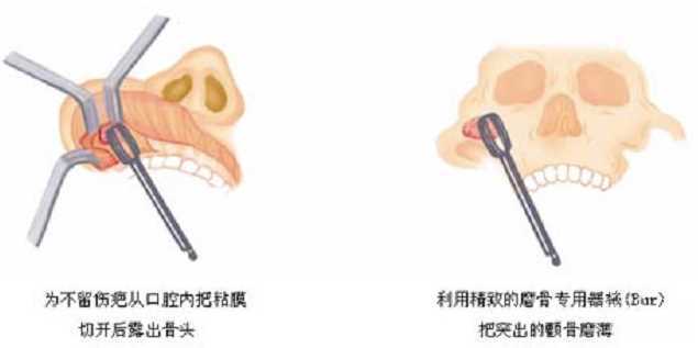 削骨手术如何避免后遗症 削骨手术介绍
