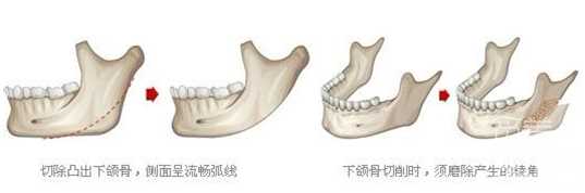 重庆华美整形医院磨腮削骨怎么样？多少钱？