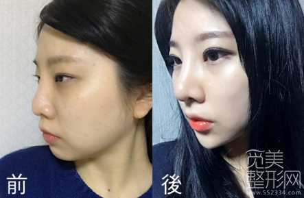 双眼皮,鼻子修复手术术后4周案例图分享
