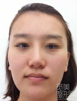 下颌角整形术 颧骨降低 面部激光溶脂 术后6个月