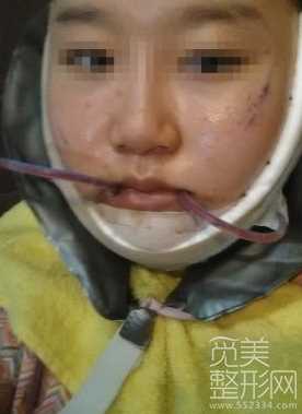 下颌角整形术 颧骨降低 面部激光溶脂 术后6个月