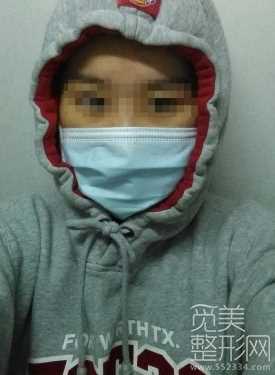 下颌角整形术 颧骨降低 面部激光溶脂 术后6个月