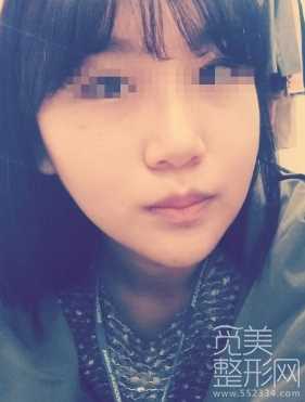 下颌角整形术 颧骨降低 面部激光溶脂 术后6个月