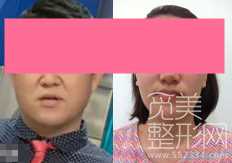 下颌角整形术 颧骨降低 面部激光溶脂 术后6个月