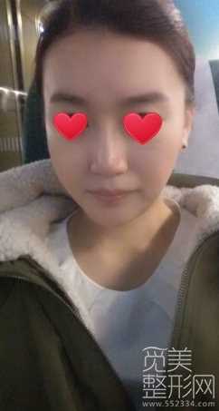 下颌角整形术 颧骨降低 面部激光溶脂 术后6个月
