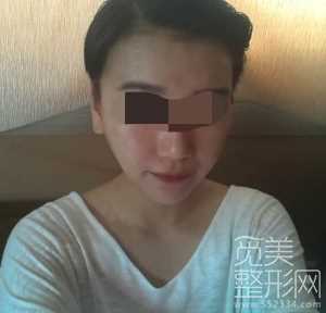 下颌角整形术 颧骨降低 面部激光溶脂 术后6个月