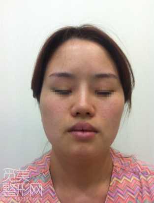 颧骨缩小 下颌角削骨 激光溶脂手术术后6个月了
