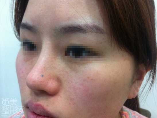 颧骨缩小 下颌角削骨 激光溶脂手术术后6个月了