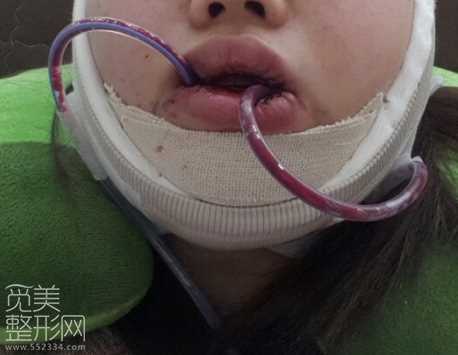 颧骨缩小 下颌角削骨 激光溶脂手术术后6个月了