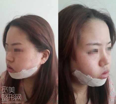 颧骨缩小 下颌角削骨 激光溶脂手术术后6个月了