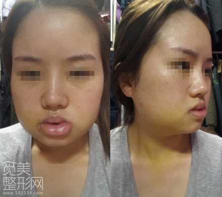 颧骨缩小 下颌角削骨 激光溶脂手术术后6个月了