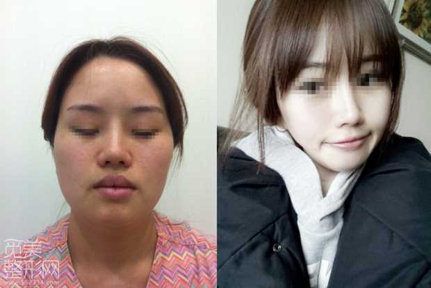 颧骨缩小 下颌角削骨 激光溶脂手术术后6个月了