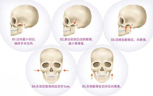颧骨内推手术*果怎么样？颧骨内推手术介绍