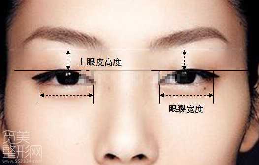 欧式大平行双眼皮如何做?怎样的适合自己