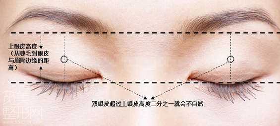 欧式大平行双眼皮如何做?怎样的适合自己