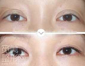 欧式大平行双眼皮如何做?怎样的适合自己