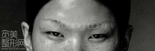 欧式大平行双眼皮如何做?怎样的适合自己